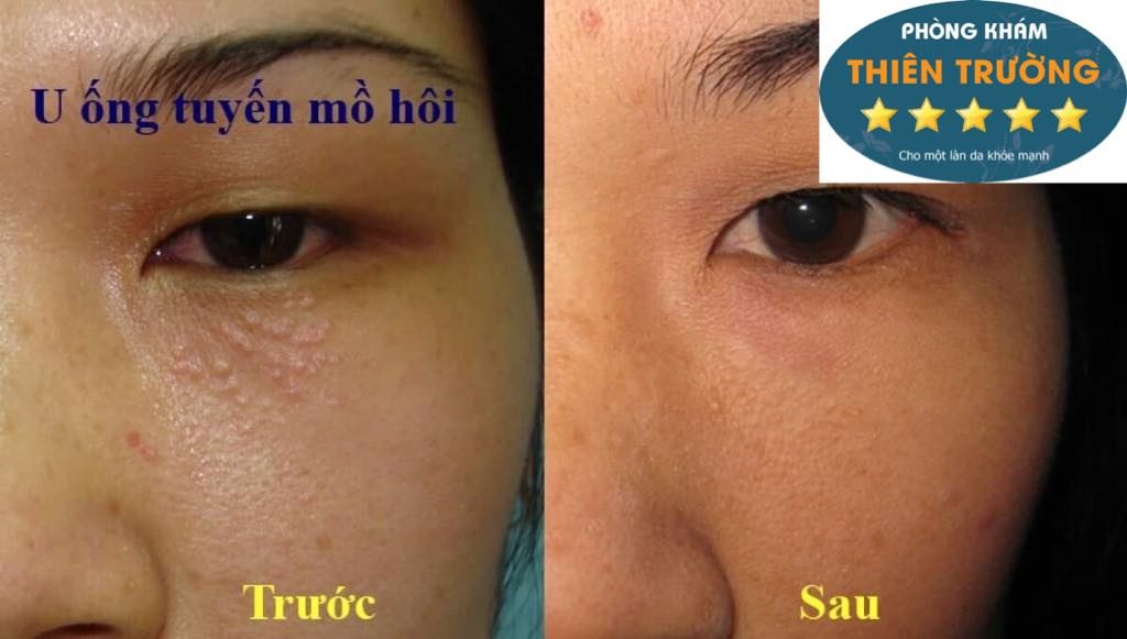 ảnh hưởng triệt lông tuyến mồ hôi ảnh hưởng triệt lông tuyến mồ hôi