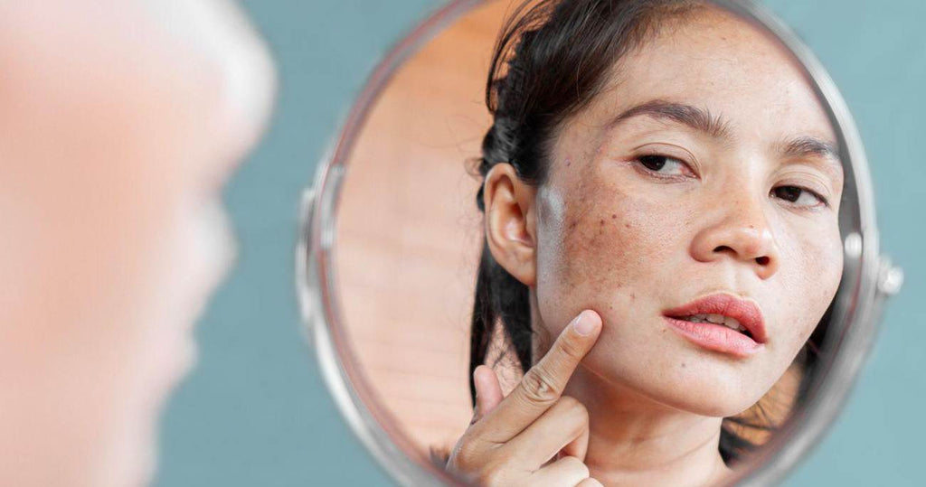 Triệt lông sạm da