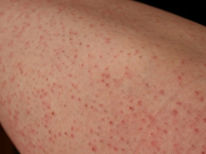 tẩy lông triệt lông so sánh tẩy lông triệt lông so sánh