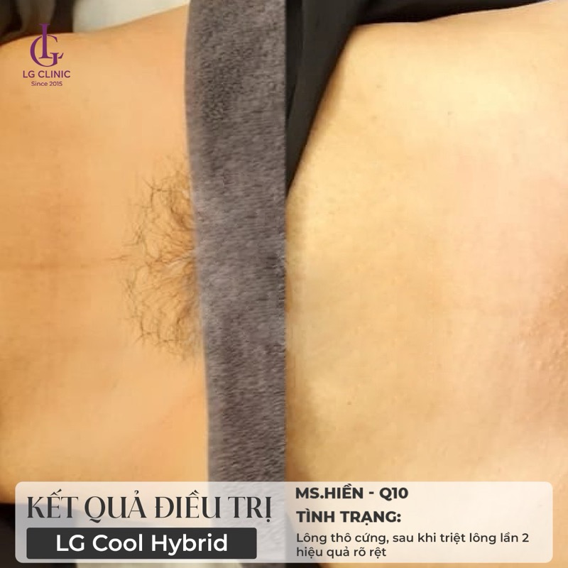 triệt lông da sạm màu