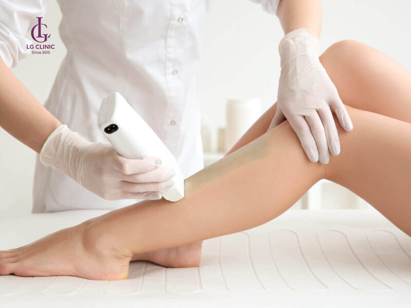 * triệt lông laser