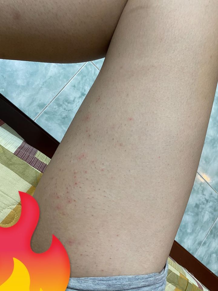 Dấu hiệu da bị kích ứng sau khi triệt