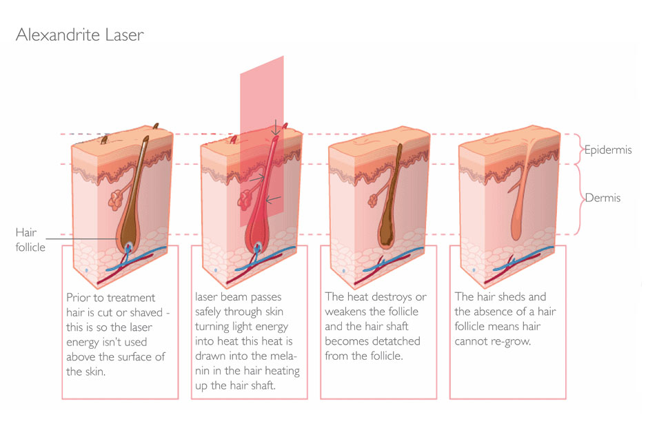 IPL vs Laser hair removal