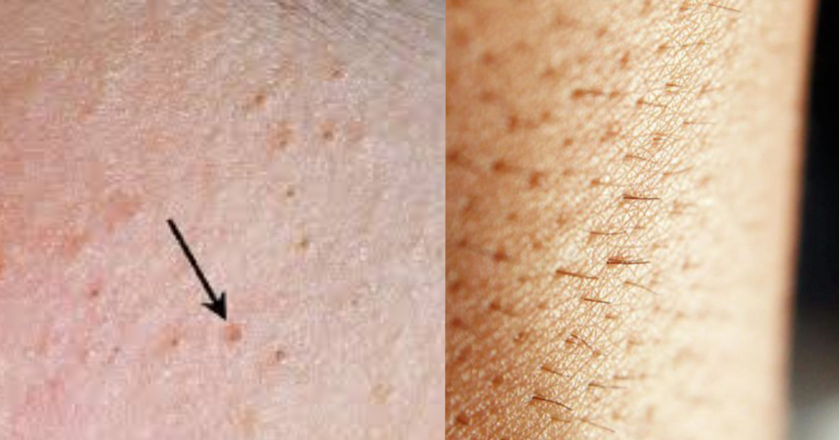 da kích ứng sau triệt lông, mẩn đỏ sau triệt lông, viêm nang lông sau triệt, nổi mụn sau triệt lông, da sưng đỏ sau triệt