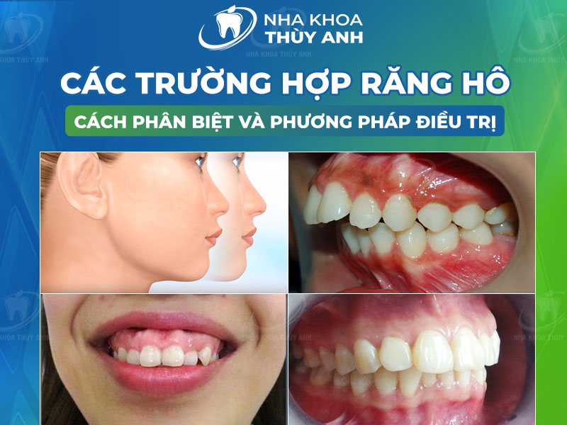So sánh phương pháp