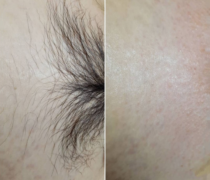 Triệt lông từng vùng cơ thể