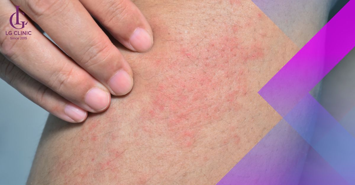 da bị kích ứng sau triệt lông