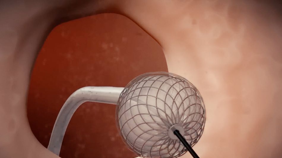 phương pháp tự nhiên kém hiệu quả