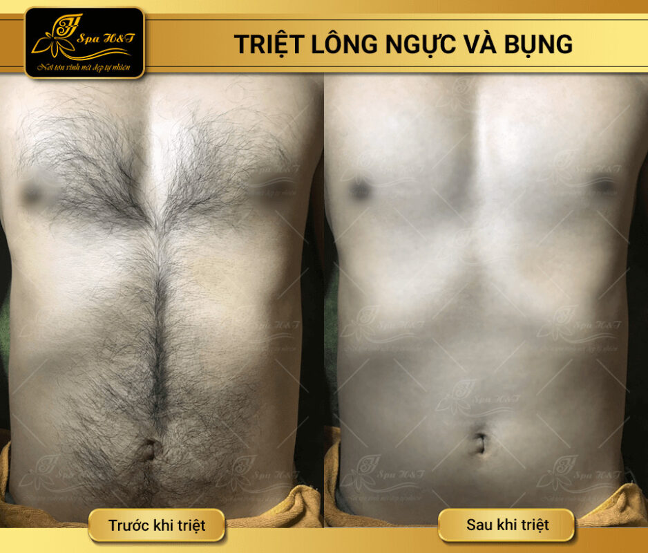 triệt lông lưng vai