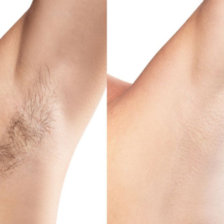 Da mịn màng sau triệt lông Da mịn màng sau triệt lông